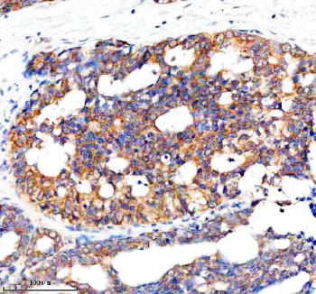 Immunohistochemical staining of NCR3LG1 using anti-NCR3LG1 antibody. NCR3LG1 was detected in a paraffin-embedded section of human breast cancer tissue. Heat mediated antigen retrieval was performed in EDTA buffer (pH 8.0, epitope retrieval solution). The tissue section was blocked with 10% goat serum. The tissue section was then incubated with 2 ug/ml rabbit anti-NCR3LG1 antibody overnight at 4oC. Peroxidase Conjugated Goat Anti-rabbit IgG was used as secondary antibody and incubated for 30 minutes at 37oC. The tissue section was developed using an HRP secondary and DAB substrate.