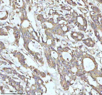 Immunohistochemical staining of MALSU1 using anti-MALSU1 antibody. MALSU1 was detected in a paraffin-embedded section of human colon adenocarcinoma tissue. Heat mediated antigen retrieval was performed in EDTA buffer (pH 8.0, epitope retrieval solution). The tissue section was blocked with 10% goat serum. The tissue section was then incubated with 2 ug/ml rabbit anti-MALSU1 antibody overnight at 4oC. Peroxidase Conjugated Goat Anti-rabbit IgG was used as secondary antibody and incubated for 30 minutes at 37oC. The tissue section was developed using an HRP secondary and DAB substrate.