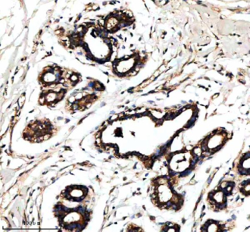 Immunohistochemical staining of RALGAPB using anti-RALGAPB antibody. RALGAPB was detected in a paraffin-embedded section of human breast cancer tissue. Heat mediated antigen retrieval was performed in EDTA buffer (pH 8.0, epitope retrieval solution). The tissue section was blocked with 10% goat serum. The tissue section was then incubated with 2 ug/ml rabbit anti-RALGAPB antibody overnight at 4oC. Peroxidase Conjugated Goat Anti-rabbit IgG was used as secondary antibody and incubated for 30 minutes at 37oC. The tissue section was developed using an HRP secondary and DAB substrate.