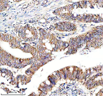 Immunohistochemical staining of NDUF-S2 using anti-NDUF-S2 antibody. NDUF-S2 was detected in a paraffin-embedded section of human colon cancer tissue. Heat mediated antigen retrieval was performed in EDTA buffer (pH 8.0, epitope retrieval solution). The tissue section was blocked with 10% goat serum. The tissue section was then incubated with 1:50 rabbit anti-NDUF-S2 antibody overnight at 4oC. Peroxidase Conjugated Goat Anti-rabbit IgG was used as secondary antibody and incubated for 30 minutes at 37oC. The tissue section was developed using an HRP secondary and DAB substrate.