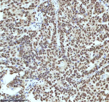 Immunohistochemical staining of IRF2BP1 using anti-IRF2BP1 antibody. IRF2BP1 was detected in a paraffin-embedded section of human ovarian cancer tissue. Heat mediated antigen retrieval was performed in EDTA buffer (pH 8.0, epitope retrieval solution). The tissue section was blocked with 10% goat serum. The tissue section was then incubated with 2 ug/ml rabbit anti-IRF2BP1 antibody overnight at 4oC. Peroxidase Conjugated Goat Anti-rabbit IgG was used as secondary antibody and incubated for 30 minutes at 37oC. The tissue section was developed using an HRP secondary and DAB substrate.