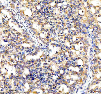 Immunohistochemical staining of CYP7B1 using anti-CYP7B1 antibody. CYP7B1 was detected in a paraffin-embedded section of human breast cancer tissue. Heat mediated antigen retrieval was performed in EDTA buffer (pH 8.0, epitope retrieval solution). The tissue section was blocked with 10% goat serum. The tissue section was then incubated with 2 ug/ml rabbit anti-CYP7B1 antibody overnight at 4oC. Peroxidase Conjugated Goat Anti-rabbit IgG was used as secondary antibody and incubated for 30 minutes at 37oC. The tissue section was developed using an HRP secondary and DAB substrate.