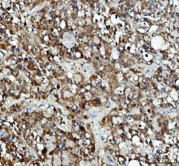 Immunohistochemical staining of DCTPP1 using anti-DCTPP1 antibody. DCTPP1 was detected in a paraffin-embedded section of human liver cancer tissue. Heat mediated antigen retrieval was performed in EDTA buffer (pH 8.0, epitope retrieval solution). The tissue section was blocked with 10% goat serum. The tissue section was then incubated with 2 ug/ml rabbit anti-DCTPP1 antibody overnight at 4oC. Peroxidase Conjugated Goat Anti-rabbit IgG was used as secondary antibody and incubated for 30 minutes at 37oC. The tissue section was developed using an HRP secondary and DAB substrate.