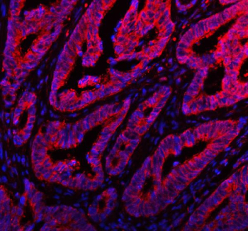 Immunofluorescent staining of FFPE human colon cancer tissue with ARHGEF7 antibody (red) and DAPI nuclear stain (blue). HIER: steam section in pH8 EDTA buffer for 20 min.