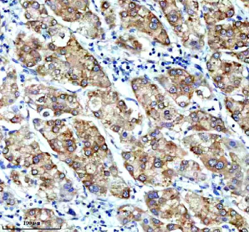 Immunohistochemical staining of CBR1 using anti-CBR1 antibody. CBR1 was detected in a paraffin-embedded section of human liver cancer tissue. Heat mediated antigen retrieval was performed in EDTA buffer (pH 8.0, epitope retrieval solution). The tissue section was blocked with 10% goat serum. The tissue section was then incubated with 1:50 rabbit anti-CBR1 antibody overnight at 4oC. Peroxidase Conjugated Goat Anti-rabbit IgG was used as secondary antibody and incubated for 30 minutes at 37oC. The tissue section was developed using an HRP secondary and DAB substrate.