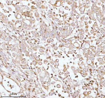 Immunohistochemical staining of PLBD2 using anti-PLBD2 antibody. PLBD2 was detected in a paraffin-embedded section of human lung adenocarcinoma tissue. Heat mediated antigen retrieval was performed in EDTA buffer (pH 8.0, epitope retrieval solution). The tissue section was blocked with 10% goat serum. The tissue section was then incubated with 2 ug/ml rabbit anti-PLBD2 antibody overnight at 4oC. Peroxidase Conjugated Goat Anti-rabbit IgG was used as secondary antibody and incubated for 30 minutes at 37oC. The tissue section was developed using an HRP secondary and DAB substrate.