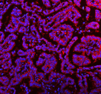 Immunofluorescent staining of FFPE human lung cancer tissue with RNF25 antibody (red) and DAPI nuclear stain (blue). HIER: steam section in pH8 EDTA buffer for 20 min.
