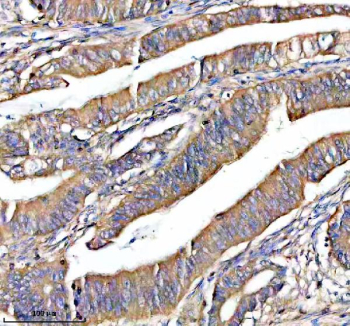 Immunohistochemical staining of NOXO1 using anti-NOXO1 antibody. NOXO1 was detected in a paraffin-embedded section of human colon cancer tissue. Heat mediated antigen retrieval was performed in EDTA buffer (pH 8.0, epitope retrieval solution). The tissue section was blocked with 10% goat serum. The tissue section was then incubated with 2 ug/ml rabbit anti-NOXO1 antibody overnight at 4oC. Peroxidase Conjugated Goat Anti-rabbit IgG was used as secondary antibody and incubated for 30 minutes at 37oC. The tissue section was developed using an HRP secondary and DAB substrate.