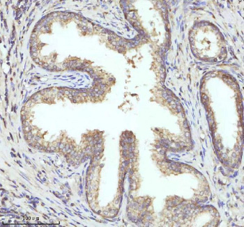 Immunohistochemical staining of PIPOX using anti-PIPOX antibody. PIPOX was detected in a paraffin-embedded section of human prostate cancer tissue. Heat mediated antigen retrieval was performed in EDTA buffer (pH 8.0, epitope retrieval solution). The tissue section was blocked with 10% goat serum. The tissue section was then incubated with 2 ug/ml rabbit anti-PIPOX antibody overnight at 4oC. Peroxidase Conjugated Goat Anti-rabbit IgG was used as secondary antibody and incubated for 30 minutes at 37oC. The tissue section was developed using an HRP secondary and DAB substrate.