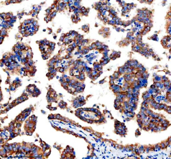 Immunohistochemical staining of GEF-H1/ARHGEF2 using anti-ARHGEF2 antibody. GEF-H1/ARHGEF2 was detected in a paraffin-embedded section of human ovary cancer tissue. Heat mediated antigen retrieval was performed in EDTA buffer (pH 8.0, epitope retrieval solution). The tissue section was blocked with 10% goat serum. The tissue section was then incubated with 2 ug/ml rabbit anti-ARHGEF2 antibody overnight at 4oC. Peroxidase Conjugated Goat Anti-rabbit IgG was used as secondary antibody and incubated for 30 minutes at 37oC. The tissue section was developed using an HRP secondary and DAB substrate.