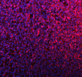 Immunofluorescent staining of SILV/PMEL using anti-PMEL antibody (red). SILV/PMEL was detected in a paraffin-embedded section of human melanoma tissue. Heat mediated antigen retrieval was performed in EDTA buffer (pH 8.0, epitope retrieval solution). The tissue section was blocked with 10% goat serum. The tissue section was then incubated with 5 ug/ml rabbit anti-PMEL antibody overnight at 4oC. DyLight 594 Conjugated Goat Anti-Rabbit IgG was used as secondary antibody at 1:500 dilution and incubated for 30 minutes at 37oC. The section was counterstained with DAPI nuclear stain (blue). Visualize using a fluorescence microscope and filter sets appropriate for the label used.
