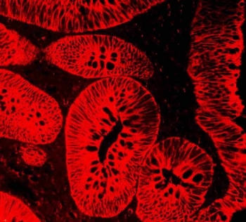 Immunofluorescent staining of FFPE human rectal cancer tissue with Cytokeratin 18 antibody. HIER: steam section in pH8 EDTA buffer for 20 min.