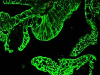 Immunofluorescent staining of FFPE human intestinal cancer with pan Cytokeratin antibody. HIER: steam section in pH8 EDTA buffer for 20 min.