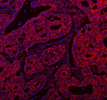 Immunofluorescent staining of FFPE human intestinal cancer tissue with SSH3BP1 antibody (red) and DAPI nuclear stain (blue). HIER: steam section in pH8 EDTA buffer for 20 min.