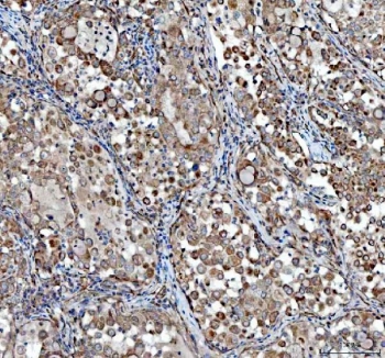 IHC staining of FFPE human lung cancer tissue with TCP1 alpha antibody. HIER: boil tissue sections in pH8 EDTA for 20 min and allow to cool before testing.