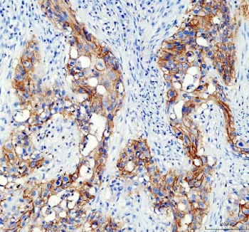 IHC staining of FFPE human bladder cancer tissue with AQP3 antibody. HIER: boil tissue sections in pH8 EDTA for 20 min and allow to cool before testing.