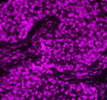 Immunofluorescent staining of FFPE human lung cancer tissue with APEX1 antibody (red). HIER: steam section in pH8 EDTA buffer for 20 min.
