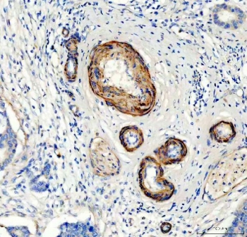 IHC testing of FFPE human breast cancer tissue with Canstatin / Collagen IV antibody at 1ug/ml. Required HIER: steam section in pH8 EDTA buffer for 20 min and allow to cool prior to staining.