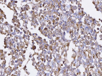 IHC staining of FFPE human pancreatic cancer tissue with BCAT1 antibody. HIER: boil tissue sections in pH8 EDTA for 20 min and allow to cool before testing.