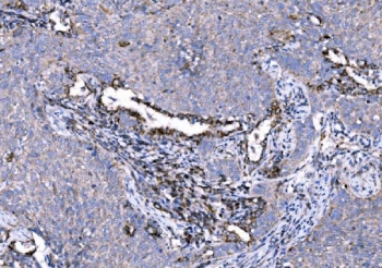 IHC staining of FFPE human lung cancer tissue with 5HT1A Receptor antibody. HIER: boil tissue sections in pH8 EDTA for 20 min and allow to cool before testing.