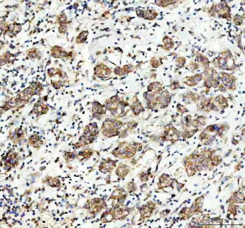 IHC staining of FFPE human breast cancer tissue with MAP3K1 antibody. HIER: boil tissue sections in pH8 EDTA for 20 min and allow to cool before testing.