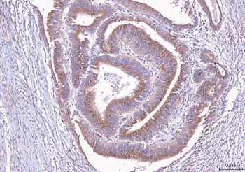 IHC staining of FFPE human rectal cancer tissue with ALDH3A1 antibody. HIER: boil tissue sections in pH8 EDTA for 20 min and allow to cool before testing.