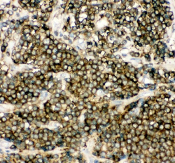IHC staining of FFPE human lung cancer tissue with NFKB1 antibody. HIER: boil tissue sections in pH8 EDTA for 20 min and allow to cool before testing.