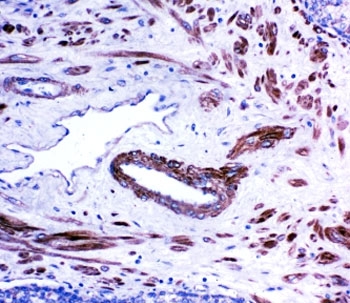 IHC-P: ACE antibody testing of human prostate cancer tissue