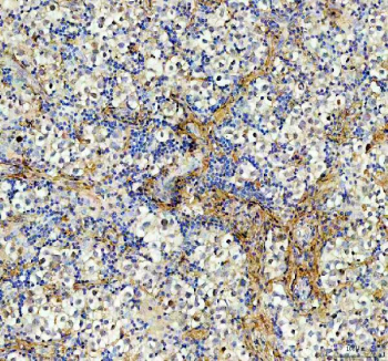 IHC staining of FFPE human testis cancer tissue with AAMP antibody, HRP-labeled secondary and DAB substrate. HIER: boil tissue sections in pH8 EDTA for 20 min and allow to cool before testing.