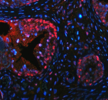 Immunofluorescent staining of FFPE human prostate hyperplasia tissue with p63 antibody (red) and DAPI nuclear stain (blue). HIER: steam section in pH8 EDTA buffer for 20 min.