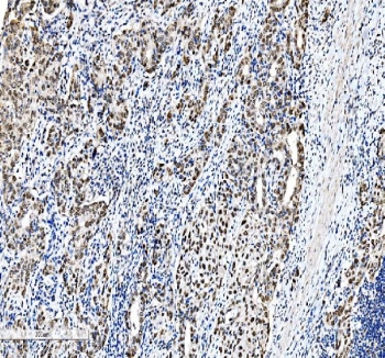 IHC staining of FFPE human squamous metaplasia of renal pelvis tissue with C/EBP beta antibody. HIER: boil tissue sections in pH8 EDTA for 20 min and allow to cool before testing.