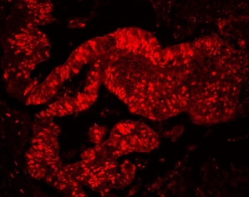 Immunofluorescent staining of FFPE human colon cancer tissue with MCM7 antibody. HIER: steam section in pH6 citrate buffer for 20 min.