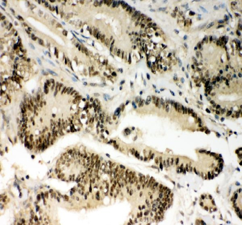 IHC staining of FFPE human colon cancer tissue with PIN1 antibody, HRP-secondary and DAB substrate. HIER: boil tissue sections in pH8 EDTA for 20 min and allow to cool before testing.