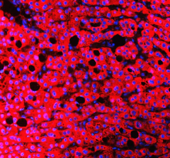 Immunofluorescent staining of FFPE human liver cancer tissue with RBP4 antibody (red) and DAPI nuclear stain (blue). HIER: steam section in pH8 EDTA buffer for 20 min.