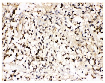 IHC staining of FFPE human glioma tissue with VCP antibody. HIER: boil tissue sections in pH8 EDTA for 20 min and allow to cool before testing.