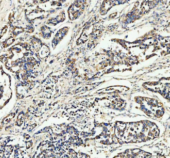 IHC staining of FFPE human lung cancer tissue with CCN1 antibody, HRP-secondary and DAB substrate. HIER: boil tissue sections in pH8 EDTA for 20 min and allow to cool before testing.