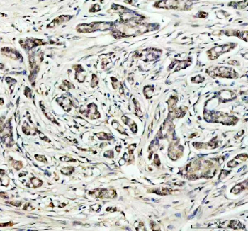 IHC staining of FFPE human breast cancer tissue with SOD1 antibody, HRP-secondary and DAB substrate. HIER: boil tissue sections in pH8 EDTA for 20 min and allow to cool before testing.