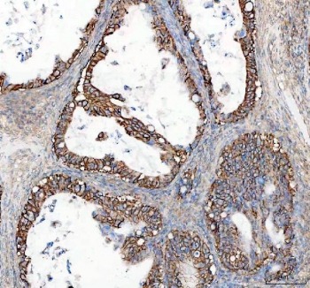 IHC staining of FFPE human ovarian cancer tissue with ATP1A1 antibody. HIER: boil tissue sections in pH8 EDTA for 20 min and allow to cool before testing.