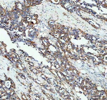 IHC staining of FFPE human pancreas cancer tissue with MGST1 antibody. HIER: boil tissue sections in pH8 EDTA for 20 min and allow to cool before testing.