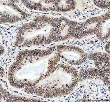 IHC staining of FFPE human stomach cancer tissue with LMNB1 antibody. HIER: boil tissue sections in pH8 EDTA for 20 min and allow to cool before testing.