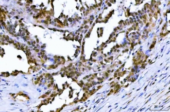 IHC staining of FFPE human ovarian serous adenocarcinoma tissue with TIF1 antibody. HIER: boil tissue sections in pH8 EDTA for 20 min and allow to cool before testing.