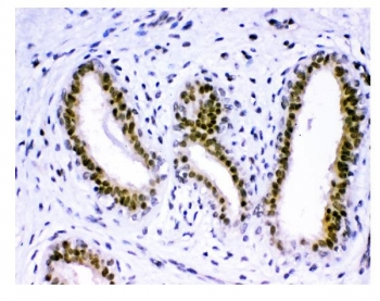 IHC staining of FFPE human breast cancer tissue with KDM5B antibody. HIER: boil tissue sections in pH8 EDTA for 20 min and allow to cool before testing.