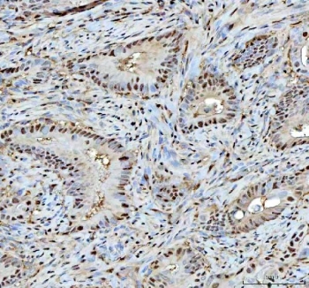 IHC staining of FFPE human rectum adenocarcinoma tissue with PSMA1 antibody. HIER: boil tissue sections in pH8 EDTA for 20 min and allow to cool before testing.