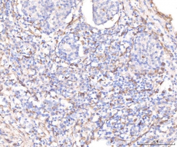 IHC staining of FFPE human lung cancer tissue with KCNQ1 antibody. HIER: boil tissue sections in pH8 EDTA for 20 min and allow to cool before testing.