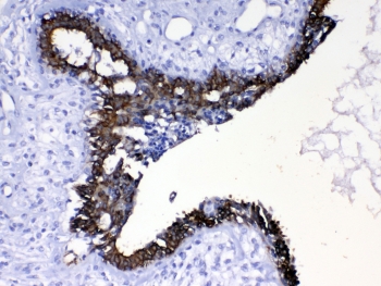 IHC testing of FFPE human breast cancer tissue with Cytokeratin 8 antibody at 1ug/ml. Required HIER: steam section in pH6 citrate buffer for 20 min and allow to cool prior to testing.