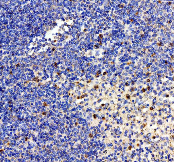 IHC staining of FFPE human spleen tissue with Interleukin-2 antibody, HRP-labeled secondary and DAB substrate. HIER: boil tissue sections in pH8 EDTA for 20 min and allow to cool before testing.