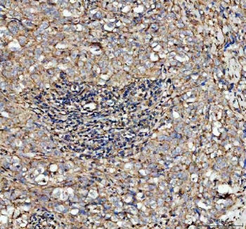 IHC staining of FFPE human breast cancer tissue with CFD antibody. Required HIER: steam section in pH8 EDTA buffer for 20 min and allow to cool prior to testing.
