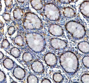 IHC staining of FFPE human colon cancer tissue with GALT antibody. HIER: boil tissue sections in pH8 EDTA for 20 min and allow to cool before testing.