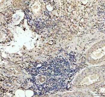 IHC staining of FFPE human lung cancer tissue with TSPAN12 antibody, HRP-labeled secondary and DAB substrate. HIER: boil tissue sections in pH8 EDTA for 20 min and allow to cool before testing.