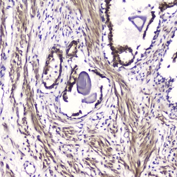 IHC testing of FFPE human prostate cancer with ATF4 antibody at 2ug/ml. HIER: boil tissue sections in pH6, 10mM citrate buffer, for 10-20 min followed by cooling at RT for 20 min.